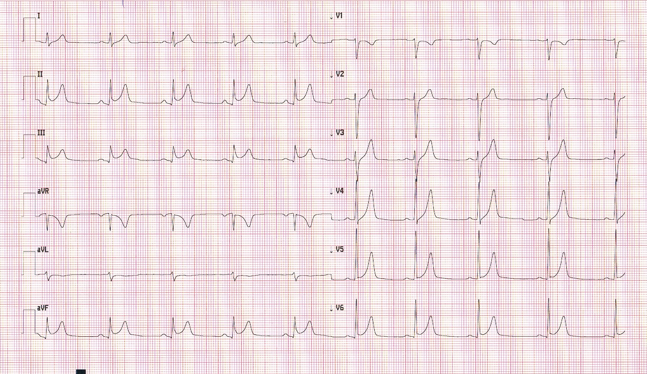EKG w ostrej fazie zapalenia mięśnia sercowego