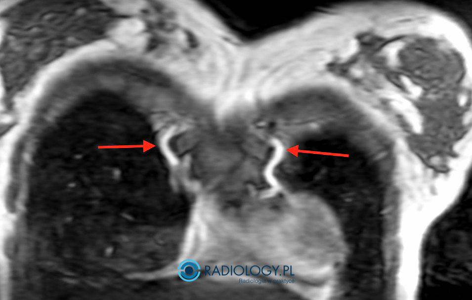 Poszerzone tętnice piersiowe wewnętrzne u pacjenta z CoA