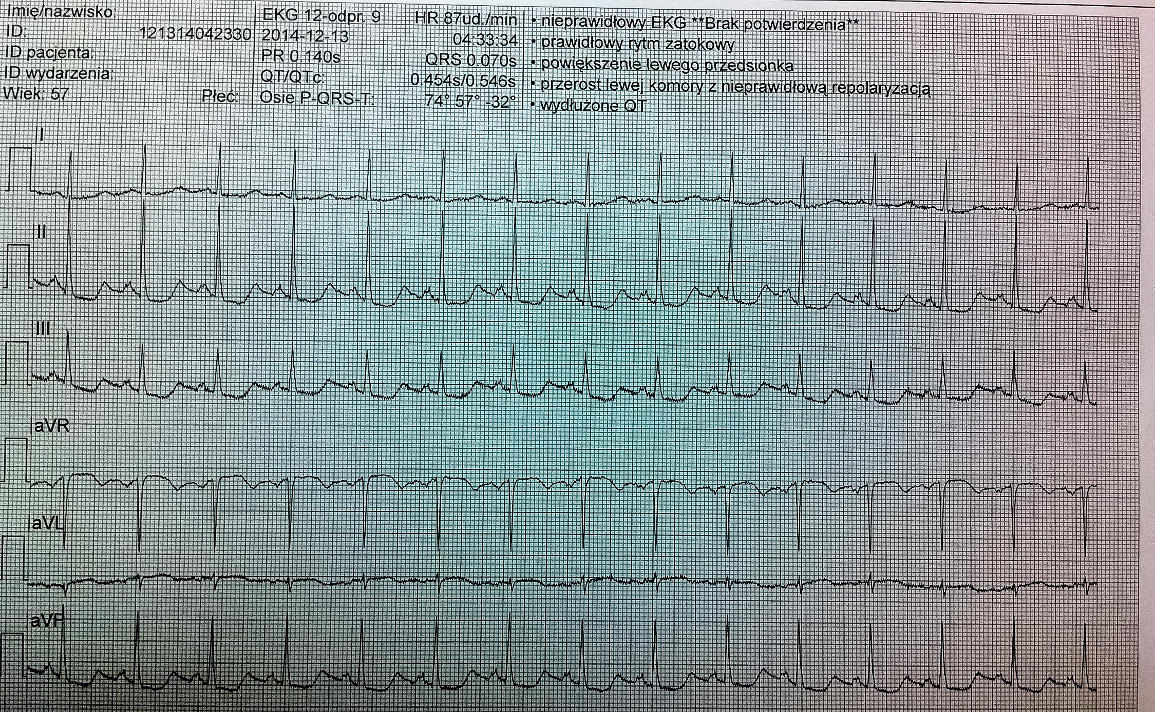 EKG z teletransmisji